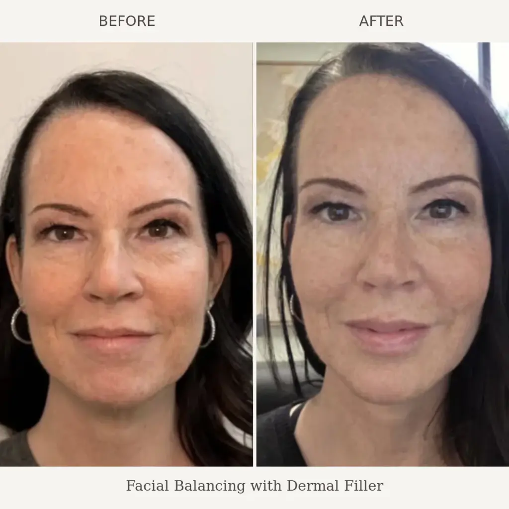 Side by side before and after photos of a woman's face showing results of facial balancing with dermal filler.