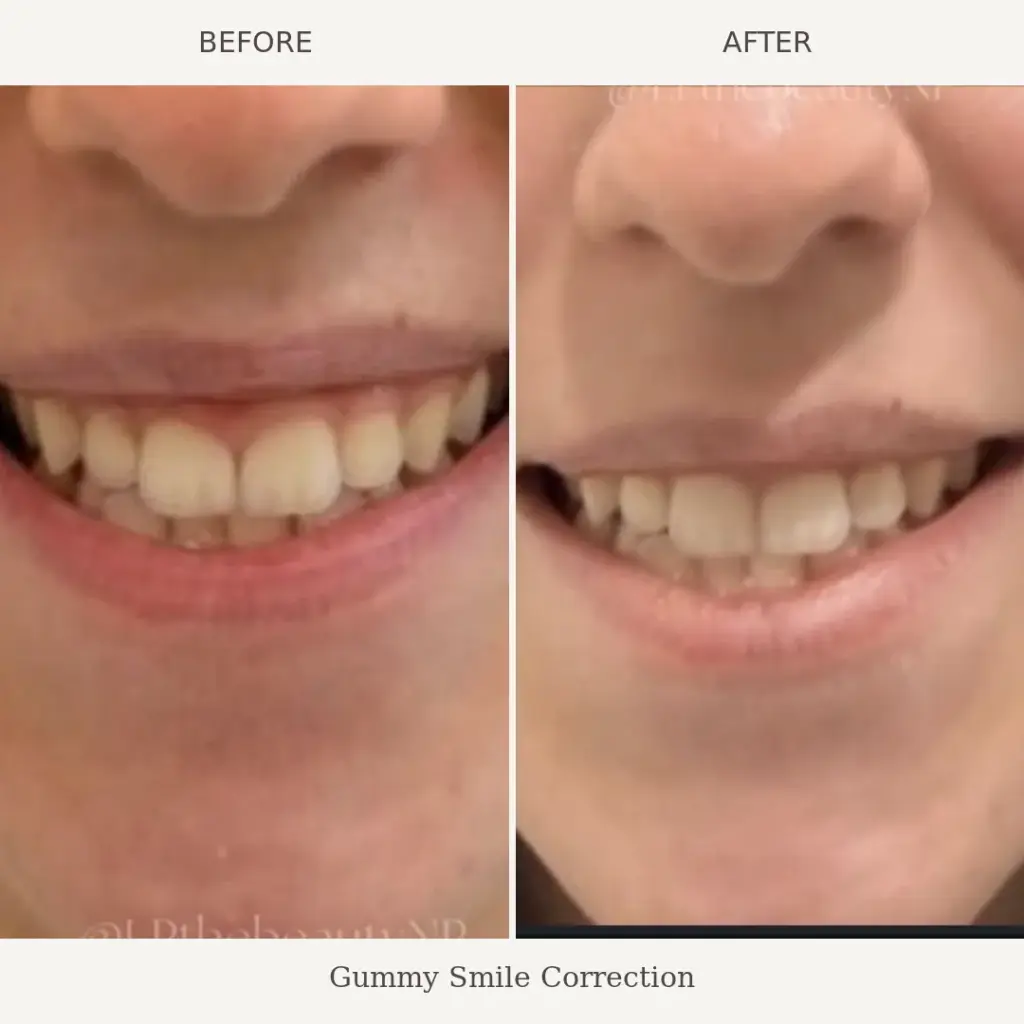 Before and after close-up of a smile showing reduced gum exposure after gummy smile correction treatment.