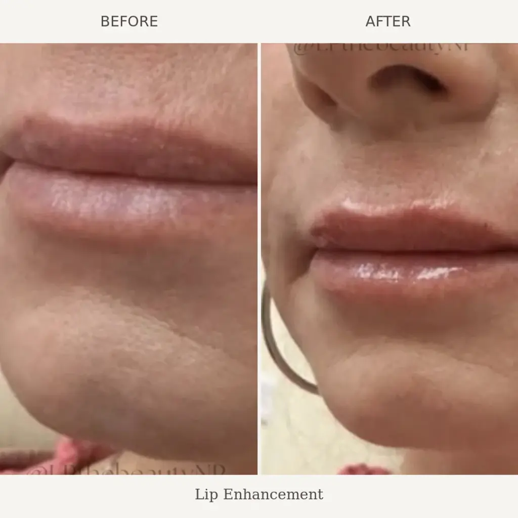 Side by side close-up of a woman's lips before and after lip filler, showing added volume and definition after treatment.