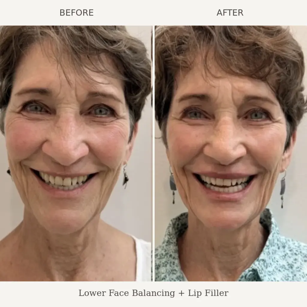 Side by side before and after of a smiling woman showing results of lower face balancing and lip filler treatment.