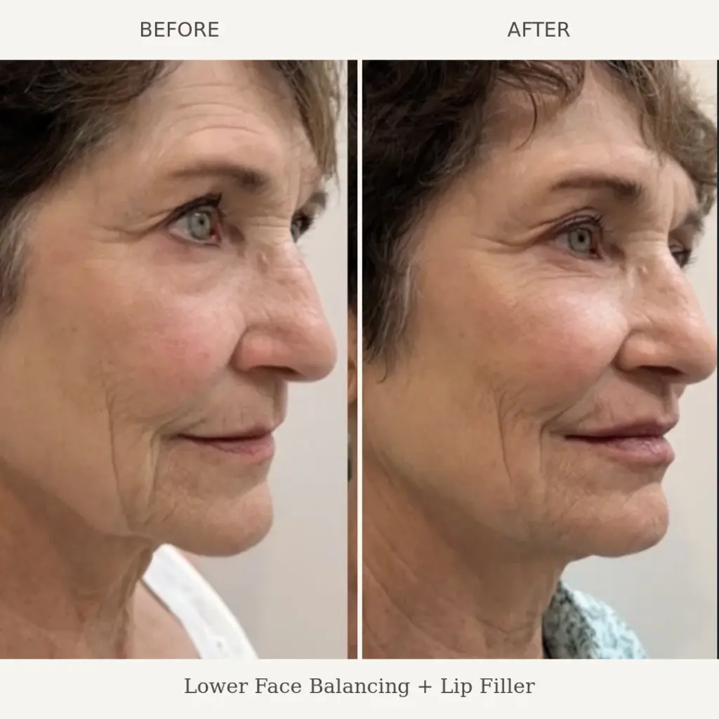 Side profile before and after photos of a woman showing lower face balancing and lip filler results